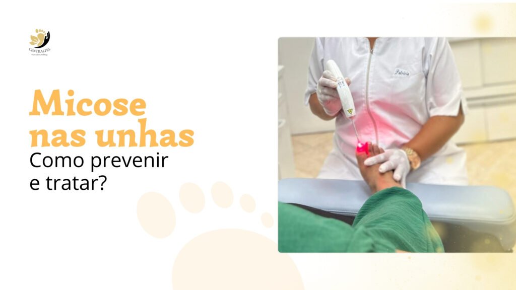 Micose nas unhas: Como prevenir e tratar?